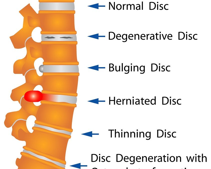 Disc Degeneration As The Cause of Lower Back Pain