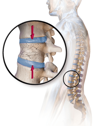 Degenerative Disc Disease Physical Therapy