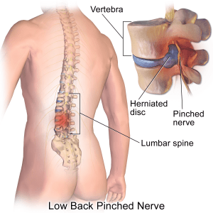 Blausen_0484_HerniatedLumbarDisc