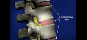 Degenerative Disc Disease YouTube