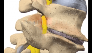 Lumbar Spine Movement Intervertebral Degenerative Disc Disease chiropractor 3D animations YouTube