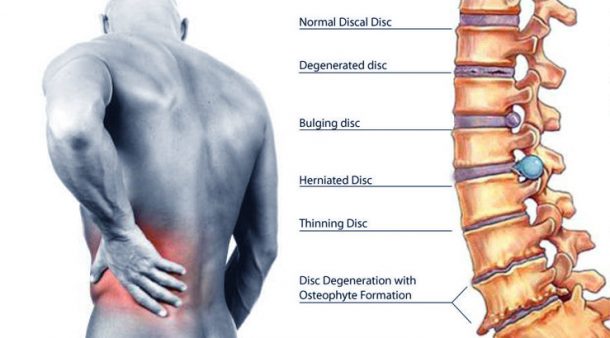 minimally-invasive-surgery-for-low-back-pain