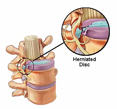 Spinal Implant Market