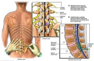 back-pain-remedy-youtube-heart-pain-back-causing-21578