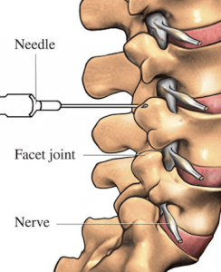 Facet-Joint-Injection-Use-this