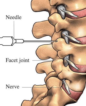 Smoking Linked to Degenerative Spine Disease