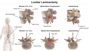 Lumbar_Laminectomy