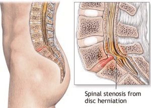 disc-herniation