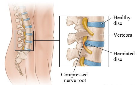 Degenerative Spine Disease