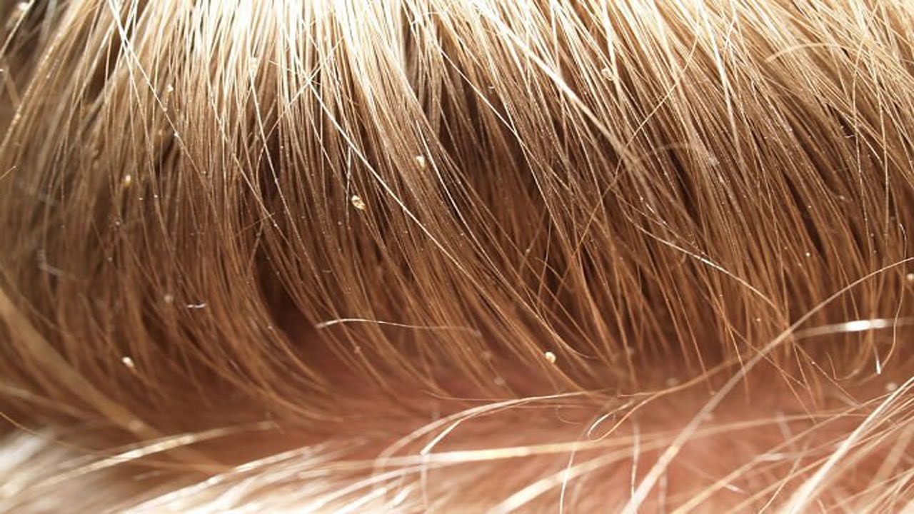 Scabies And Lice Explained Frederick Earlstein
