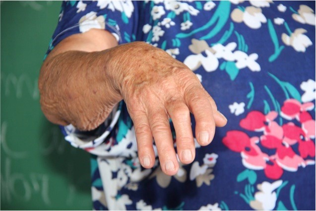 How to Recognize the Early Indications and Signs of Rheumatoid Arthritis