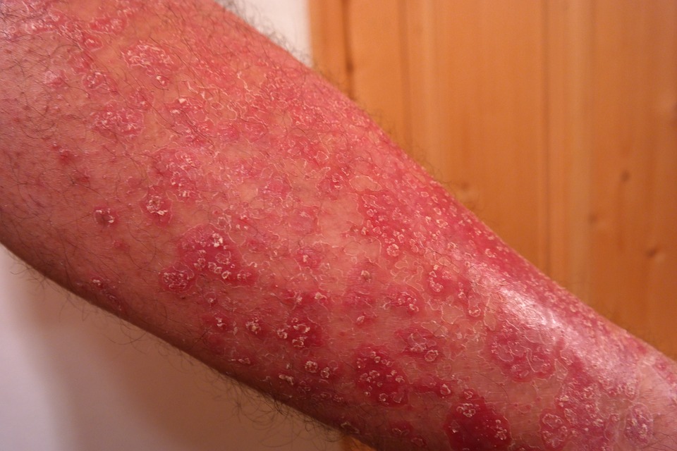 What Causes a Scabies Infestation?