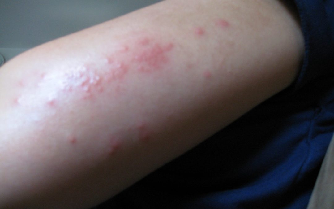 What are Over – the – Counter Treatments for Scabies?