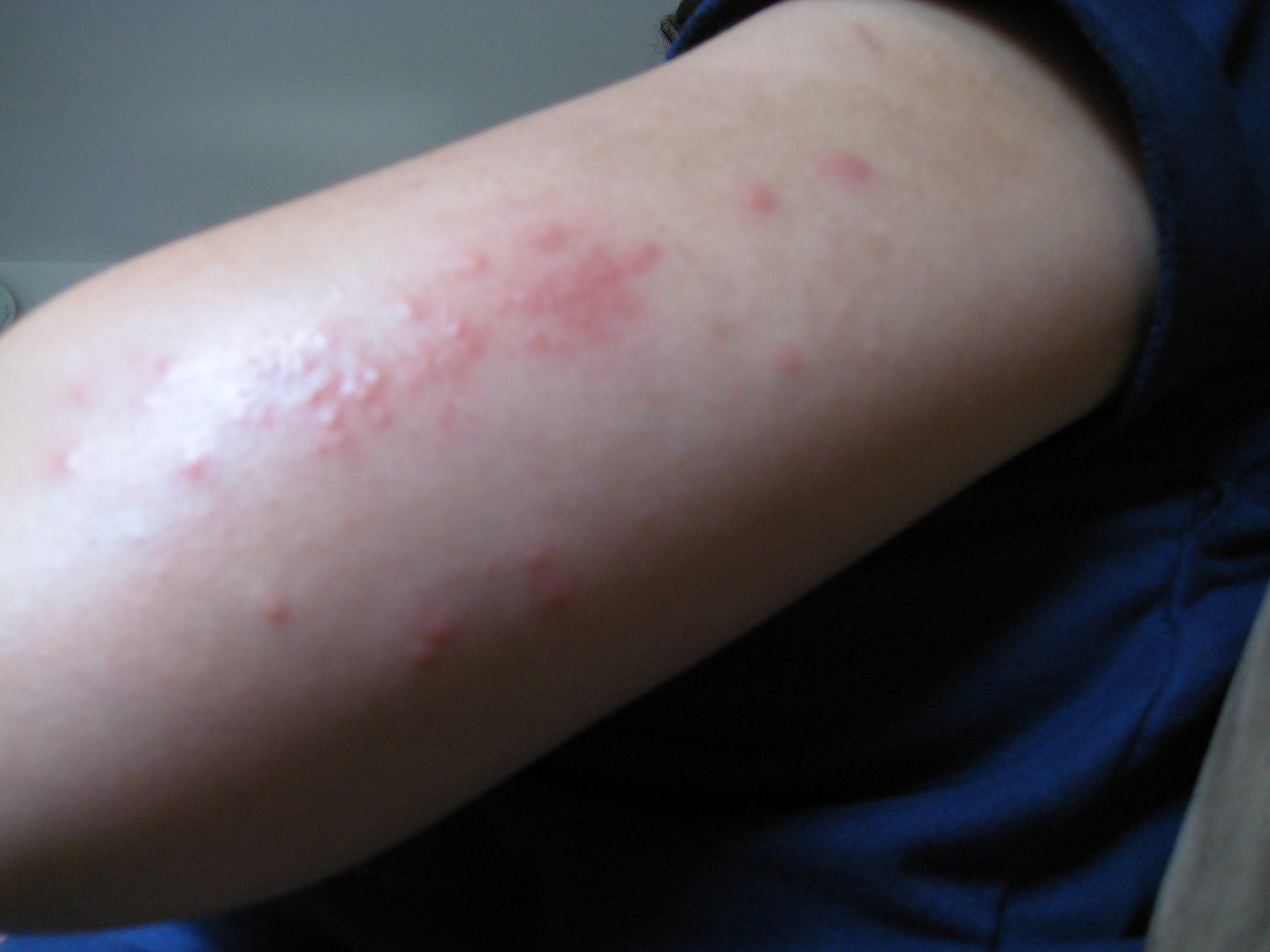 what-are-over-the-counter-treatments-for-scabies