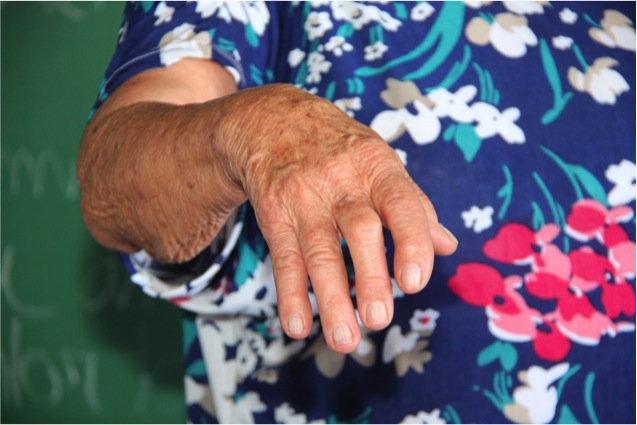What Are the Treatments for Rheumatoid Arthritis?